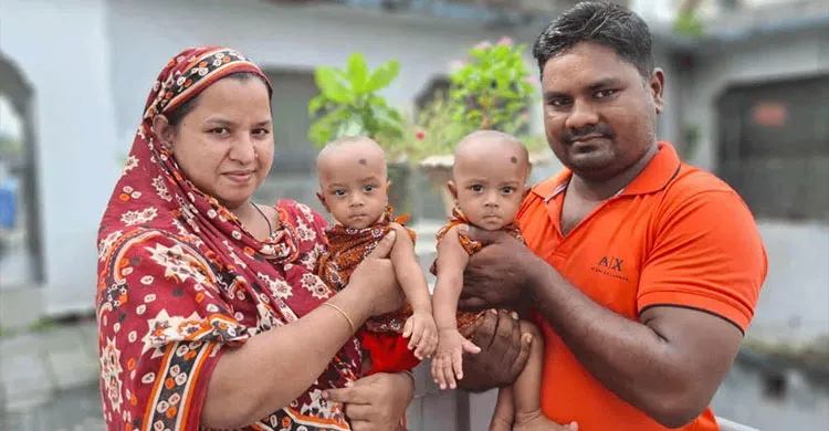 ৪ ঘণ্টার জটিল অস্ত্রোপচারে পৃথক হলো যমজ শিশু জুহি ও রুহি