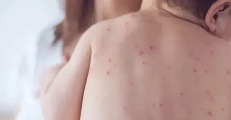 হামে আরও এক শিশুর মৃত্যু, ২৪ ঘণ্টায় হাসপাতালে ভর্তি ৬৭৪