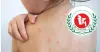 হামে ৩২৪ জনের মৃত্যু, হাসপাতালগুলোতে আক্রান্ত শিশুদের ভিড়