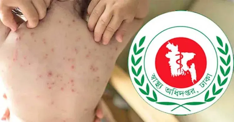 দেশে ২৪ ঘণ্টায় হাম ও উপসর্গে আরও ১৭ শিশুর মৃত্যু
