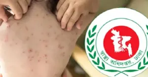 ২৪ ঘণ্টায় হাম উপসর্গে ৫ শিশুর মৃত্যু
