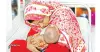 হামের উপসর্গে আরও ৩ শিশুর মৃত্যু, ২৪ ঘণ্টায় আক্রান্ত ১,০৩২