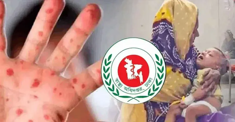 হামের উপসর্গে আরও ৭ শিশুর মৃত্যু, ২৪ ঘণ্টায় নতুন আক্রান্ত ১,২৮৭
