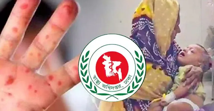 হাম ও হামের উপসর্গে আরও ৪ শিশুর মৃত্যু, ২৪ ঘণ্টায় আক্রান্ত ১,০৭৭