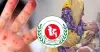 হাম ও হামের উপসর্গে আরও ৪ শিশুর মৃত্যু, ২৪ ঘণ্টায় আক্রান্ত ১,০৭৭