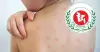 হামের উপসর্গ নিয়ে আরও ৫ শিশুর মৃত্যু, ২৪ ঘণ্টায় শনাক্ত ১,১৪৮ জন