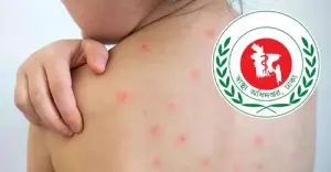 হামের উপসর্গে আরও ৭ শিশুর মৃত্যু, ২৪ ঘণ্টায় আক্রান্ত ১,০৩১