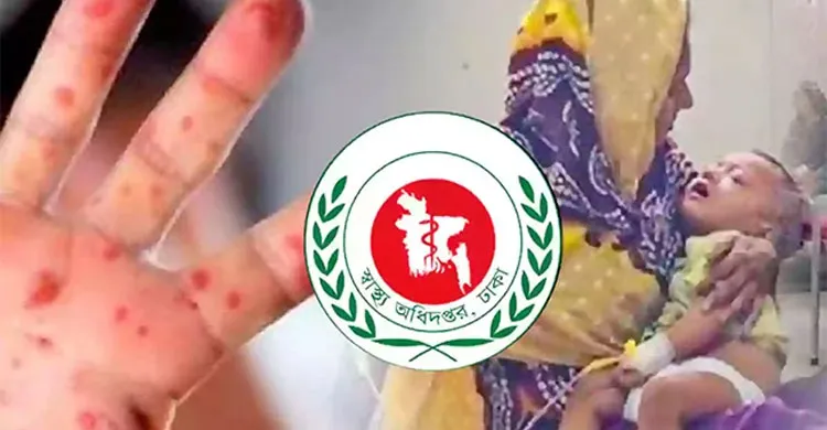 হামের উপসর্গে আরও ৪ শিশুর মৃত্যু, প্রাণহানি বেড়ে ৮২০