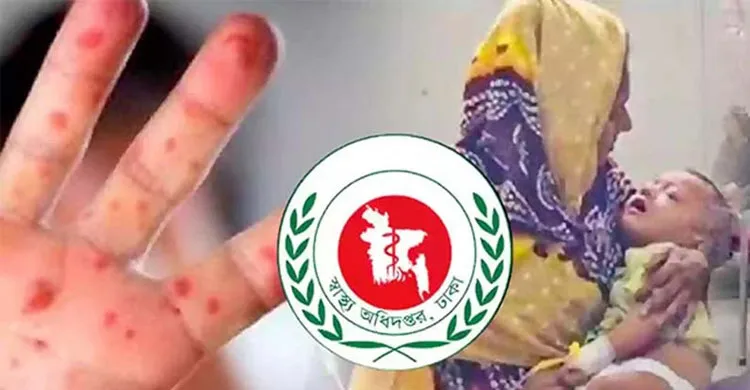 হামের উপসর্গে আরও ৫ জনের মৃত্যু, প্রাণহানি বেড়ে ৮২৫