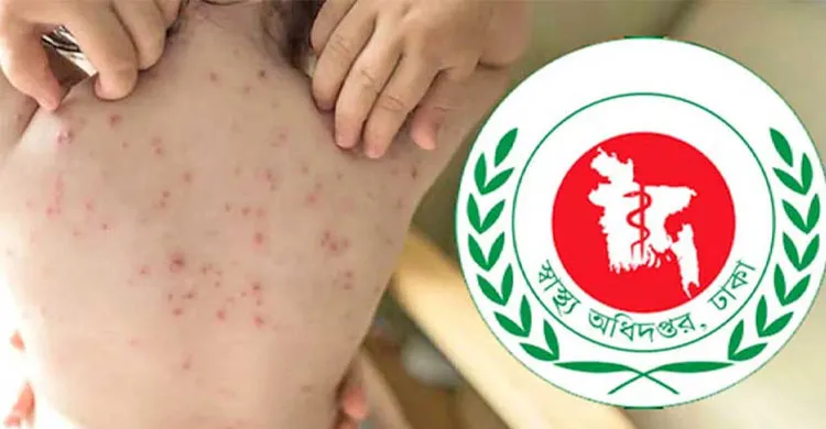 ২৪ ঘণ্টায় হামের উপসর্গে ৬ শিশুর মৃত্যু