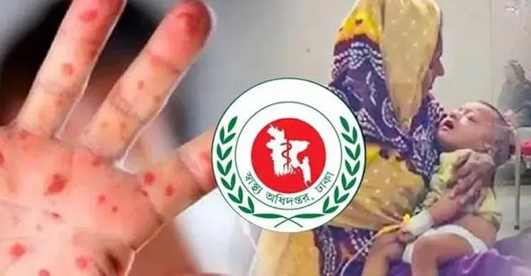 হামের উপসর্গ নিয়ে আরও ৫ শিশুর মৃত্যু, এক দিনে আক্রান্ত ১ হাজার ৩১
