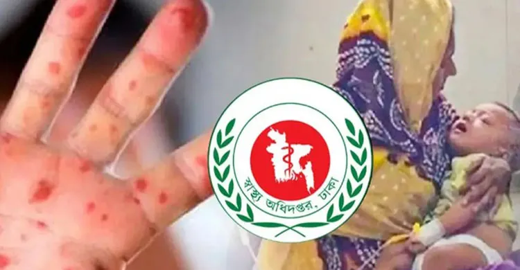 হামের উপসর্গে আরও ১১ জনের মৃত্যু, নতুন আক্রান্ত ১,২৭০